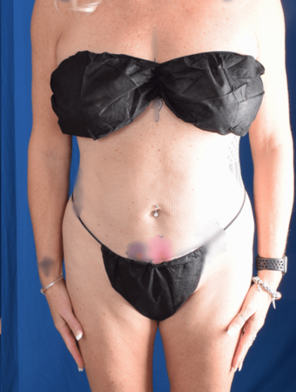 Liposuction Before & After Patient #1376