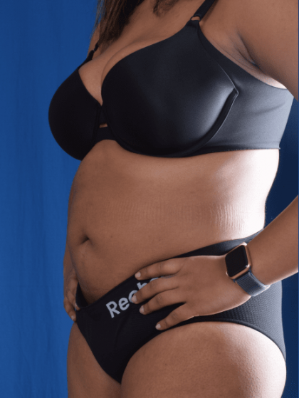 Liposuction Before & After Patient #1387