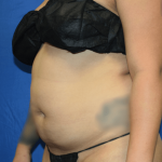 Liposuction Before & After Patient #1423