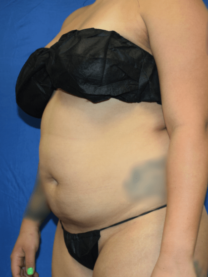 Liposuction Before & After Patient #1423