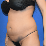 Liposuction Before & After Patient #1432