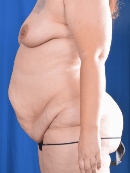 Tummy Tuck Before & After Patient #1441