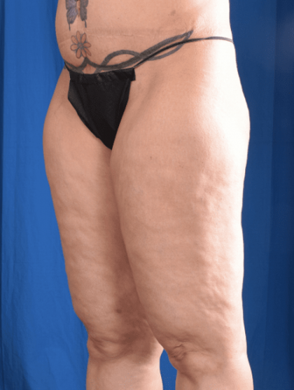 Liposuction Before & After Patient #1333