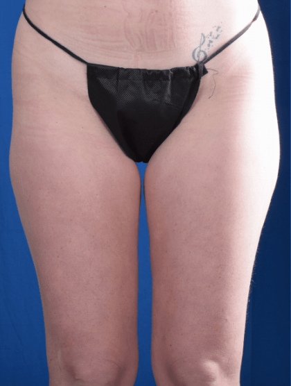Liposuction Before & After Patient #1341