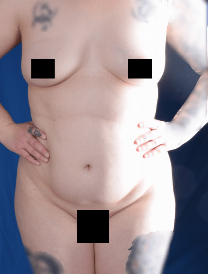 Liposuction Before & After Patient #1346