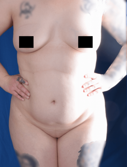 Liposuction Before & After Patient #1346