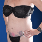 Liposuction Before & After Patient #1376