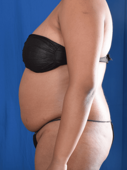 Liposuction Before & After Patient #1387