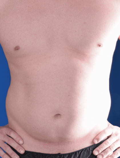 Liposuction Before & After Patient #1399
