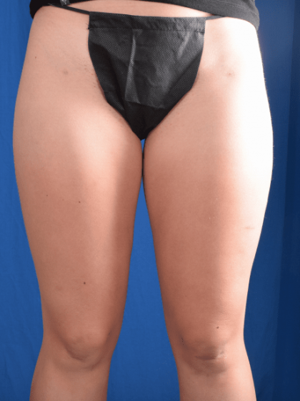 Liposuction Before & After Patient #1324