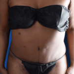 Tummy Tuck Before & After Patient #1446