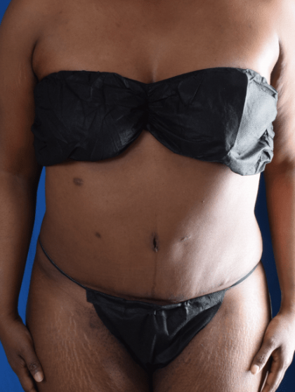Tummy Tuck Before & After Patient #1446