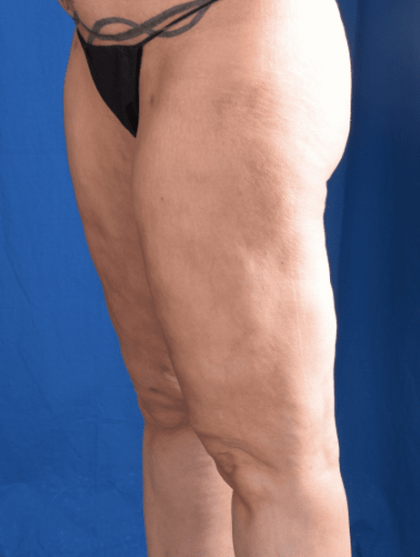 Liposuction Before & After Patient #1333