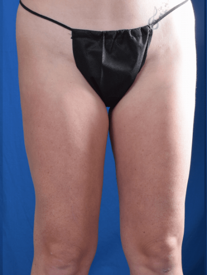 Liposuction Before & After Patient #1341