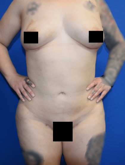 Liposuction Before & After Patient #1346