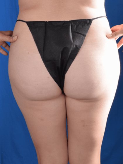 Fat Transfer to Buttocks Before & After Patient #1317
