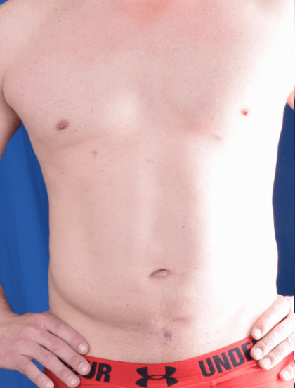 Liposuction Before & After Patient #1399