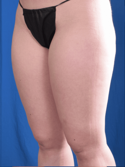 Liposuction Before & After Patient #1324