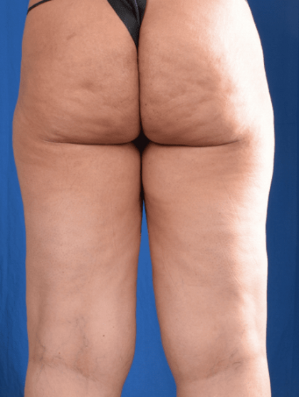 Liposuction Before & After Patient #1333