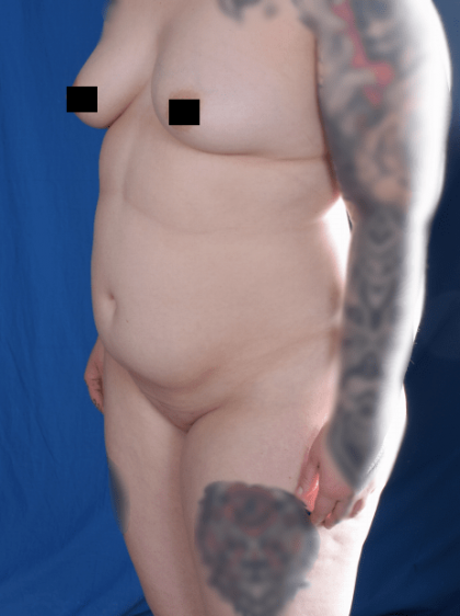 Liposuction Before & After Patient #1346