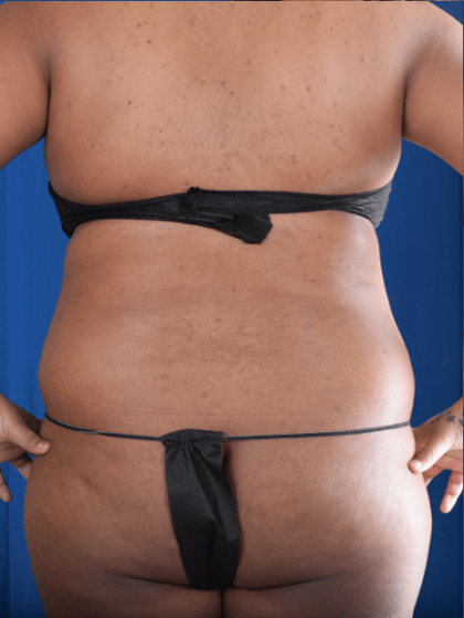Liposuction Before & After Patient #1387