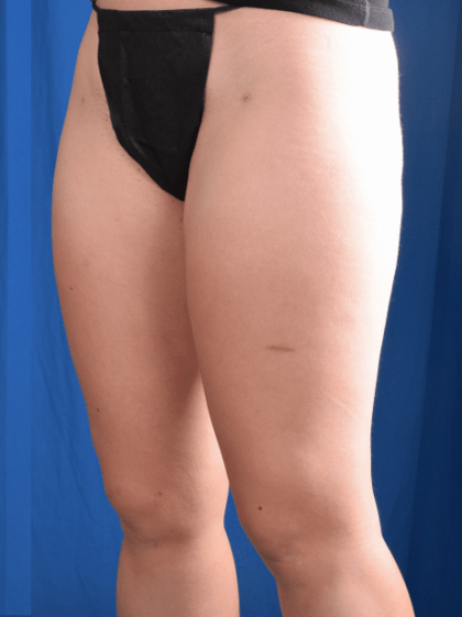 Liposuction Before & After Patient #1324