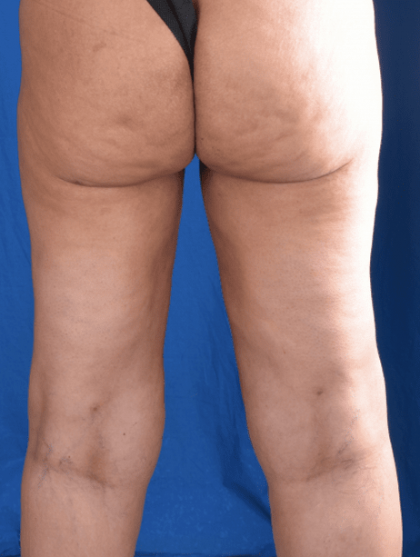 Liposuction Before & After Patient #1333