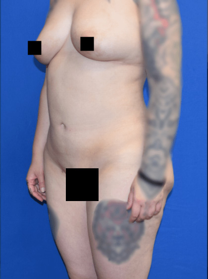Liposuction Before & After Patient #1346