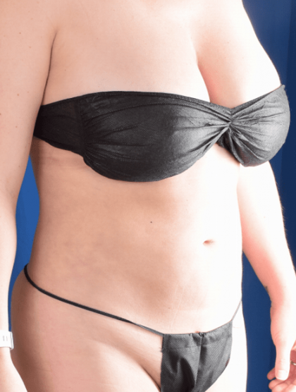 Liposuction Before & After Patient #1358
