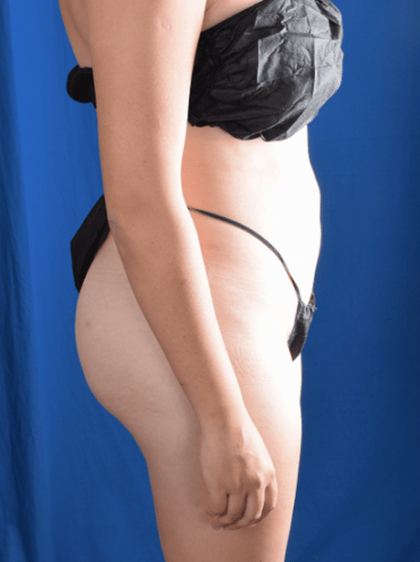 Fat Transfer to Buttocks Before & After Patient #1317