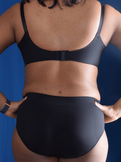 Liposuction Before & After Patient #1387