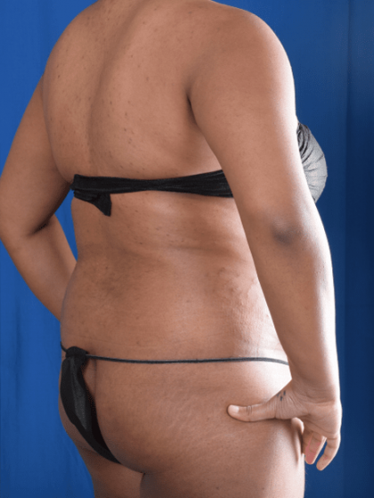 Liposuction Before & After Patient #1387