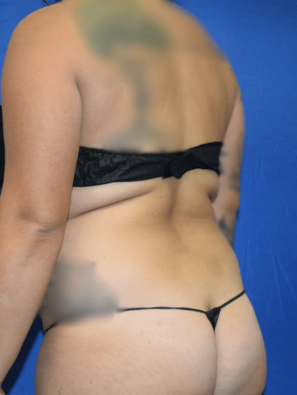 Liposuction Before & After Patient #1423