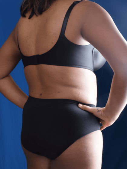 Liposuction Before & After Patient #1387