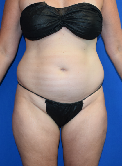 Body Before & After Patient #1507