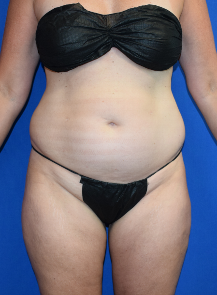 Body Before & After Patient #1507