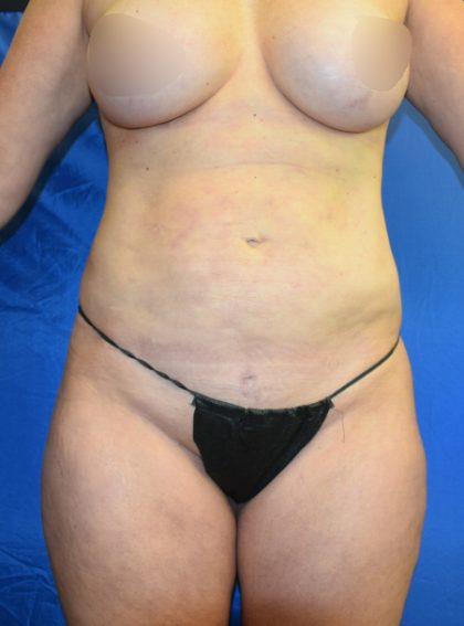 Body Before & After Patient #1507