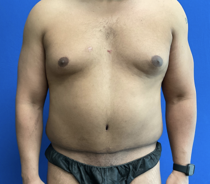 Tummy Tuck Before & After Patient #1518