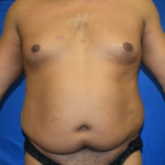 Tummy Tuck Before & After Patient #1518