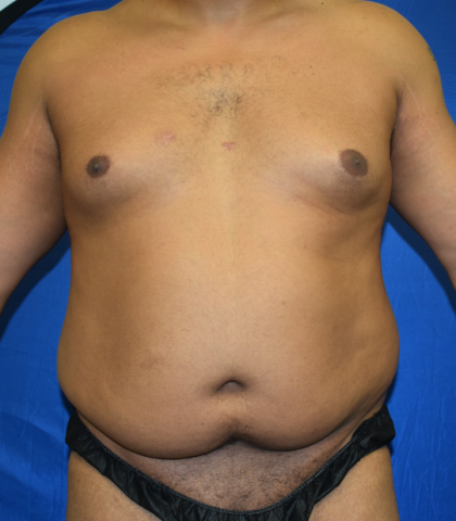 Tummy Tuck Before & After Patient #1518