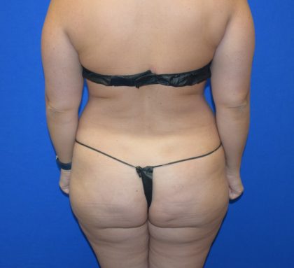 Tummy Tuck Before & After Patient #1553