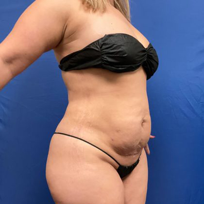 Tummy Tuck Before & After Patient #1553