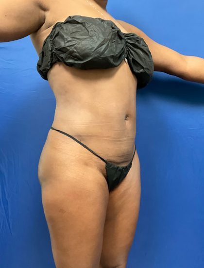 Liposuction Before & After Patient #1527