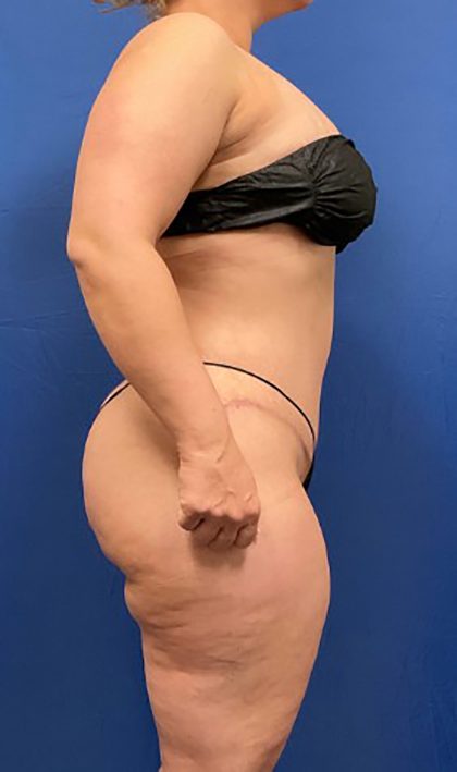 Tummy Tuck Before & After Patient #1553