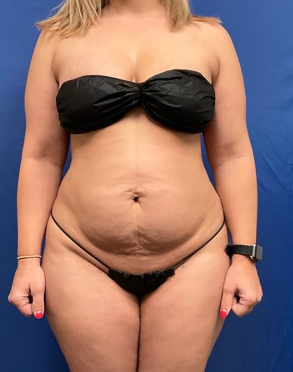 Tummy Tuck Before & After Patient #1553