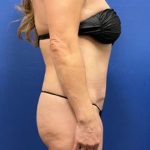 Tummy Tuck Before & After Patient #1544