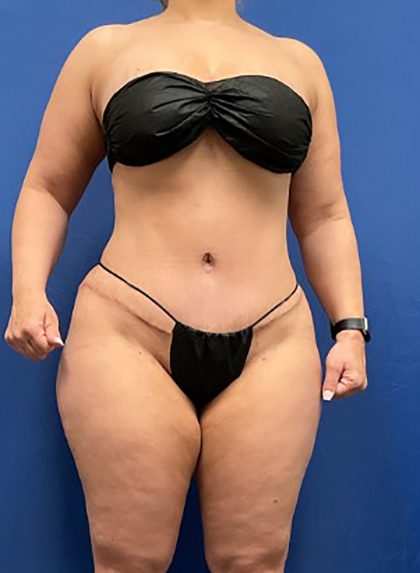 Tummy Tuck Before & After Patient #1553