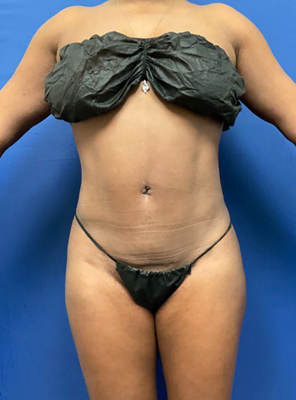 Liposuction Before & After Patient #1527