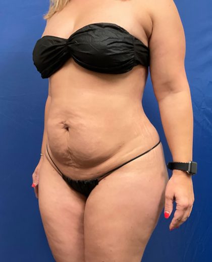 Tummy Tuck Before & After Patient #1553