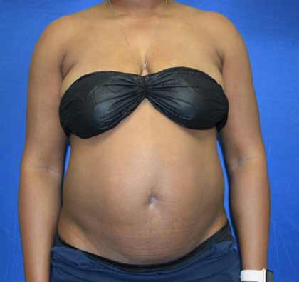 Liposuction Before & After Patient #1527